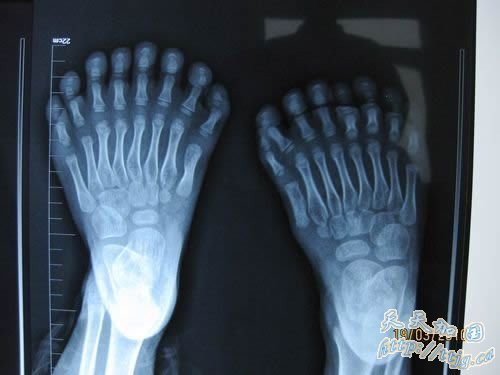 小鹏鹏的脚趾有16根