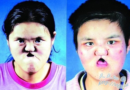 22岁女子脸部先天畸形 先后十次手术换脸(组图)