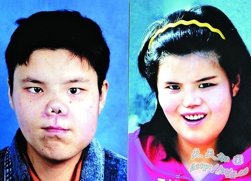 22岁女子脸部先天畸形 先后十次手术换脸(组图)