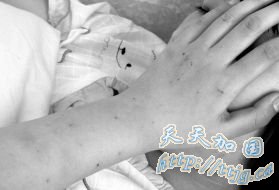 初一女孩被扎数百个针眼 称遭十余男生围殴(图)