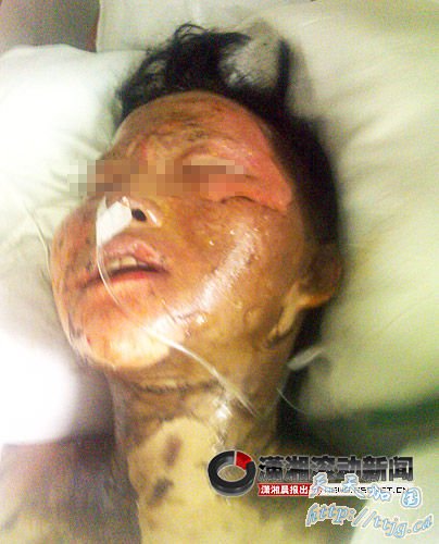 江西宜黄称3名拆迁户烧成重伤源于风力作用(图)