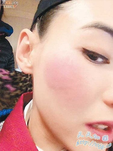 张柏芝拍戏误遭刀劈脸受伤 面部红肿险毁容