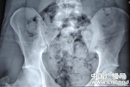 男子人体藏毒案过边检 被执勤人员查获