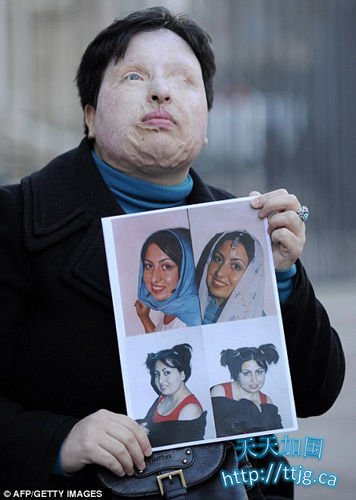 伊朗女子被泼酸毁容失明法庭判决“以眼还眼”